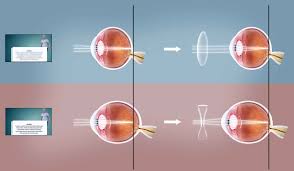 Image result for Refractive Error