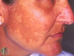 Image result for Melasma