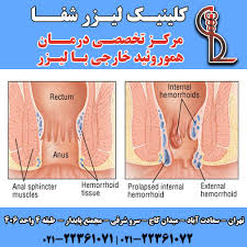 درمان بواسیر خارجی با جراحی لیزر جراحی لیزر هموروئید خارجی لیزر شفا