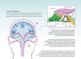 Understanding tinnitus plays an important part in learning how to cope with the condition and manage it more effectively. The Sounds Of Silence The Scientist Magazine