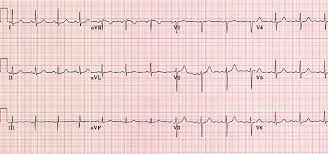 This quiz includes ecgs recorded at 25 mm/s and 50 mm/s. Ecg Ekg Examples And Quiz Oxford Medical Education