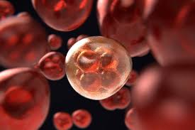 It is important to note that bone marrow cancer includes leukemias, multiple myeloma, and others. Acute Myeloid Leukemia A Cancer Of The Bone Marrow And Blood Morning Sign Out At Uci