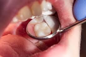 We did not find results for: Are Premolars Present In Milk Or Baby Teeth Triangle Pediatric Dentistry