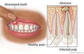 A dentist can easily tell if you are having a tooth. Abscessed Tooth In Children Care Instructions