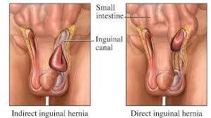 De aici pana la consultatie am avut retineri. Hernia InghinalÄƒ OperaÈ›ie FÄƒrÄƒ Durere Dr Bogdan Popescu