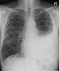 mesothelioma is rare, but in 90 percent of cases of this cancer it causes pleural effusion. Mesothelioma Summary Radiology Reference Article Radiopaedia Org