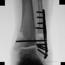 International statistical classification of diseases and related health problems. Ankle Fracture S82 843a 824 4 Eorif