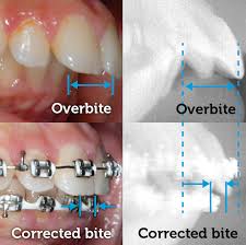 Is my orthodontist crazy or just too brilliant for the rest of the orthodontic community to keep up with? Overbite Corrected With Braces South Brunswick Nj