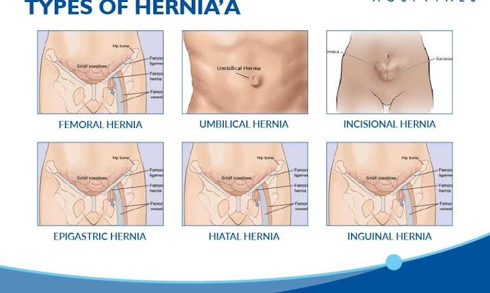 EVERYTHING YOU NEED TO KNOW ABOUT ABDOMINAL HERNIA SURGERY