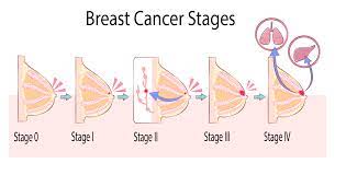 breast cancer is one of the most common cancers, and the growing statistics are concerning. What Are My Surgery Options After Breast Cancer Treatment Methodist Healthcare
