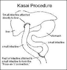The Kasai Procedure Involves Removing The Blocked Bile Ducts And Gallbladder And Replacing Them With A Segment Of Your Child The More You Know Kasai Transplant