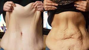 Check spelling or type a new query. Weight Loss And Loose Skin Patients Forgotten By Nhs Bbc News
