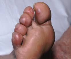 Image result for Chilblains