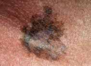 The answer to the question is pretty simple when you learn the abcde (asymmetry, borders, color, diameter, and evolving) family history of cancer or skin cancer. What Does Skin Cancer Look Like Pictures Plus Prevention Tips Cancer Dermatology Ut Southwestern Medical Center