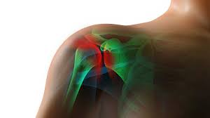 Frozen Shoulder Adhesive Capsulitis Causes Diagnosis