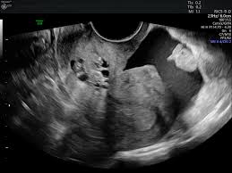 Fluid In The Pelvis | Emory School Of Medicine