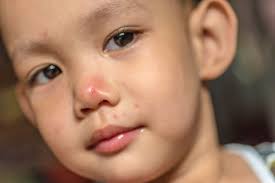 It is very contagious and most common in children under 5 years old. Summer Is Prime Time For Hand Foot And Mouth Disease