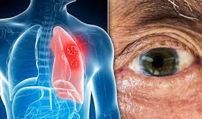 Stage 4 lung cancer symptoms. Lung Cancer Symptoms Signs Of A Tumour Include Yellow Eyes And Jaundice Express Co Uk