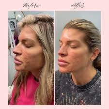 SylfirmX RF Microneedling