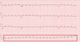 Detailed feedback on your ekg interpretations with full explanations. What Do You See In This Ecg Clinician Reviews