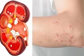 مرض الكلى متعدد الكيسات أمراض وراثية تؤدي إلى الإصابة بالفشل الكلوي الأوراس نيوز