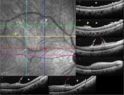 If your retina has detached, you'll need surgery to repair it, preferably within days of a diagnosis. Bare Retinal Nerve Fiber Layer And Internal Limiting Membrane Tear Associated With Epiretinal Membrane Oct Findings And Visual Outcomes Springerlink