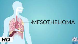 Mesothelioma is a type of cancer that develops from the thin layer of tissue that covers many of the internal organs (known as the mesothelium). Mesothelioma Causes Signs And Symptoms Diagnosis And Treatment Youtube