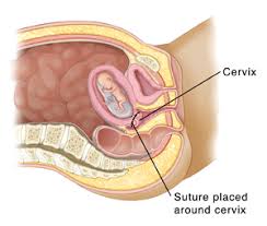 Why is checking the position of the cervix useful? Pregnancy And Childbirth Transvaginal Cerclage Saint Luke S Health System