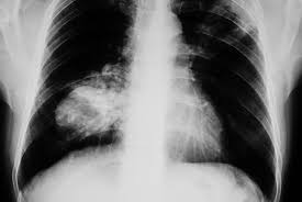 Image result for lung cancer xray