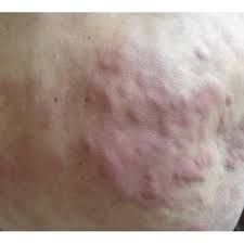 There may also be high levels of gamma globulin (antibodies) in the blood. Picture Of The Patient Taken On The Day Of Admission Showing Again The Download Scientific Diagram