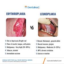 Image result for Erythroplakia roof of mouth