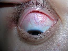 Image result for Scleritis