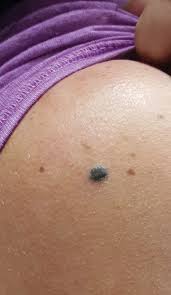 Image result for Blue Nevus