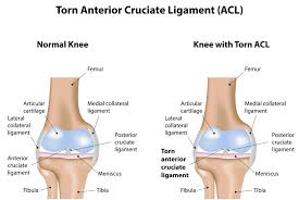 What is the degree of pain after acl reconstruction surgery? Acl Tear Knee Specialist Santa Barbara Santa Maria Ventura Ca