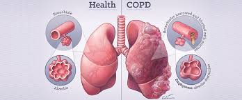 Chronic Obstructive Pulmonary Disease (COPD) - Aneurin Bevan University  Health Board