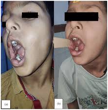 Lipomatous Hamartoma Buccal Mucosa In A Pediatric Patient: Case Report