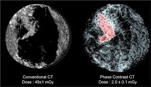 The lifetime risk from typical ct scan exposure is small for older adults sue to the long time it takes cancer to develop. Breast Cancer Scans Possible With A 25 Times Reduced Radiation Dose