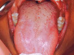 Image result for lichen planus on tongue)