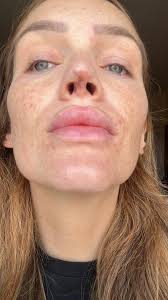 9 days until my surgery with Dr Eymen Oruc. I haven't seen much negative  feedback