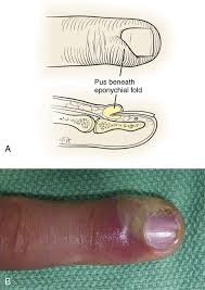 Image result for paronychium