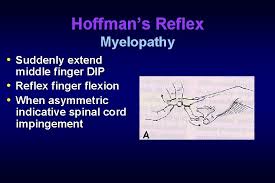 Hoffman described his test in relation to wounded soldiers at würzburg military installations, in particular 2 cases of patients with radial nerve alfonso mi, dzwierzynski w. Cervical Radiculopathy And Myelopathy Wayne Cheng Md Instructor