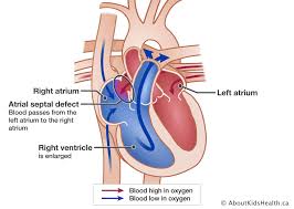 Image result for Atrial Septal Defect