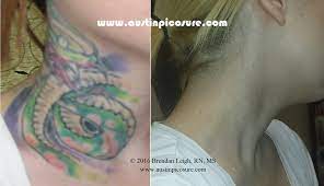 We're here to guide you through your entire tattoo removal process. Picosure Laser Tattoo Removal Can Be Life Changing Austinpicosure Com A Tattoo Removal Nurse S Notes