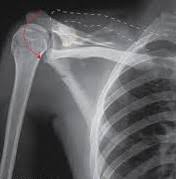 Image result for AC Dislocation