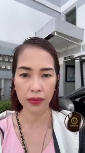 BEFORE & AFTER 2 WEEKS FACE-TOX,ALARTOX & SKIN BOOSTER BIOSTIMULATOR, ✨ Say  goodbye to wrinkles, nasal flaring, and dry, dull skin. With the help of  Facetox, Alartox, and our Skin Booster ...