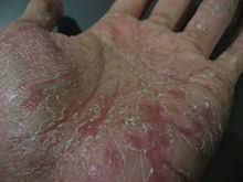 Dyshidrosis Wikipedia