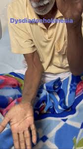 Image result for Rapid Alternating Movements