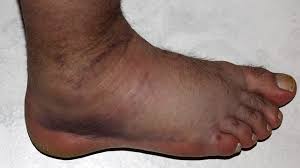 Look out for signs of your ankles or feet swelling on a plane and learn what the best approach is to prevent and treat potential health problems related to the symptom. Swollen Ankle And Leg Causes Treatments And More