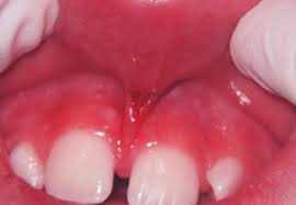 Roof of your mouth is what is described as the palate. Soft Tissue Mouth Trauma Dentist In Fort Collins Co