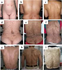 Although there is no known cure, treatment can help control symptoms. Clinical Characteristics And Spectrum Of Nf1 Mutations In 12 Unrelated Chinese Families With Neurofibromatosis Type 1 Bmc Medical Genetics Full Text